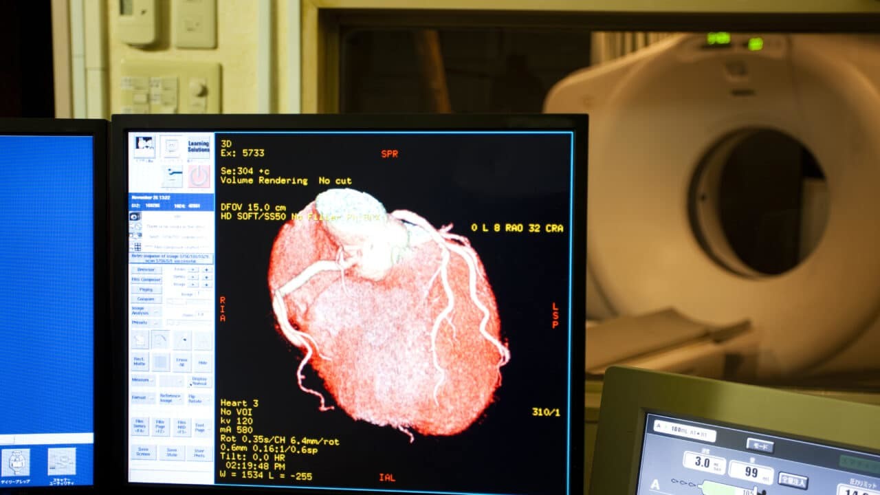 Computed Tomography Coronary Angiogram