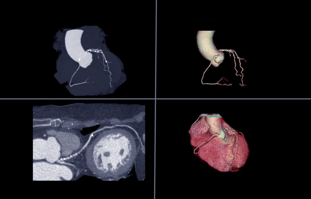 CTCA noninvasively evaluates coronary arteries using advanced diagnostic imaging technology