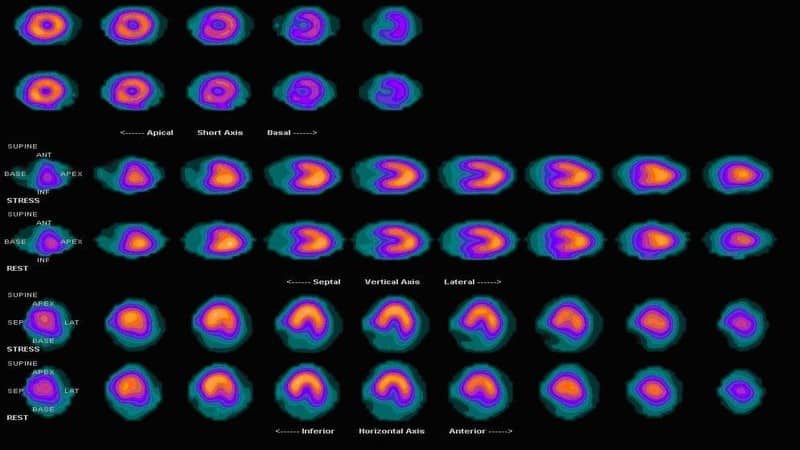 SPECT Imaging, SPECT imaging applications to myocardial perfusion and brain imaging