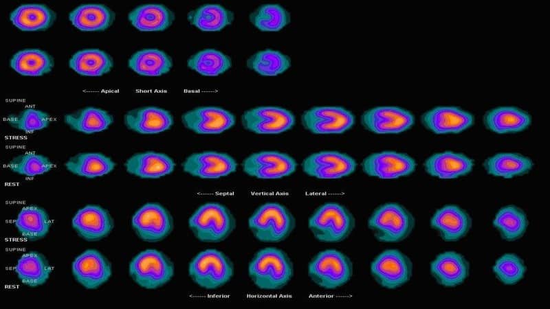 Myoview in SPECT imaging assesses cardiac perfusion and health.