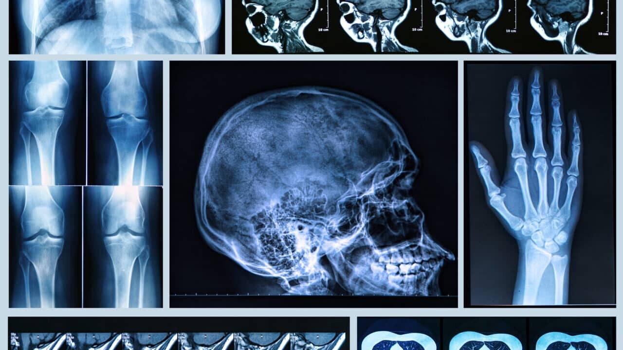 Nuclear medicine bone imaging employs radiotracers to detect abnormalities, aiding in diagnosing and monitoring conditions.