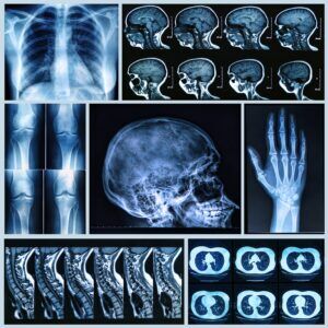 Nuclear medicine bone imaging employs radiotracers to detect abnormalities, aiding in diagnosing and monitoring conditions.