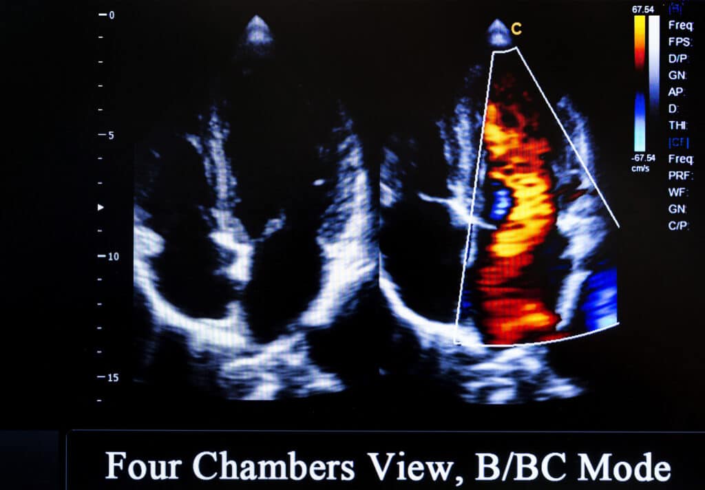 Heart imaging refers to various types of medical imaging used to visualise the structure and function of the heart
