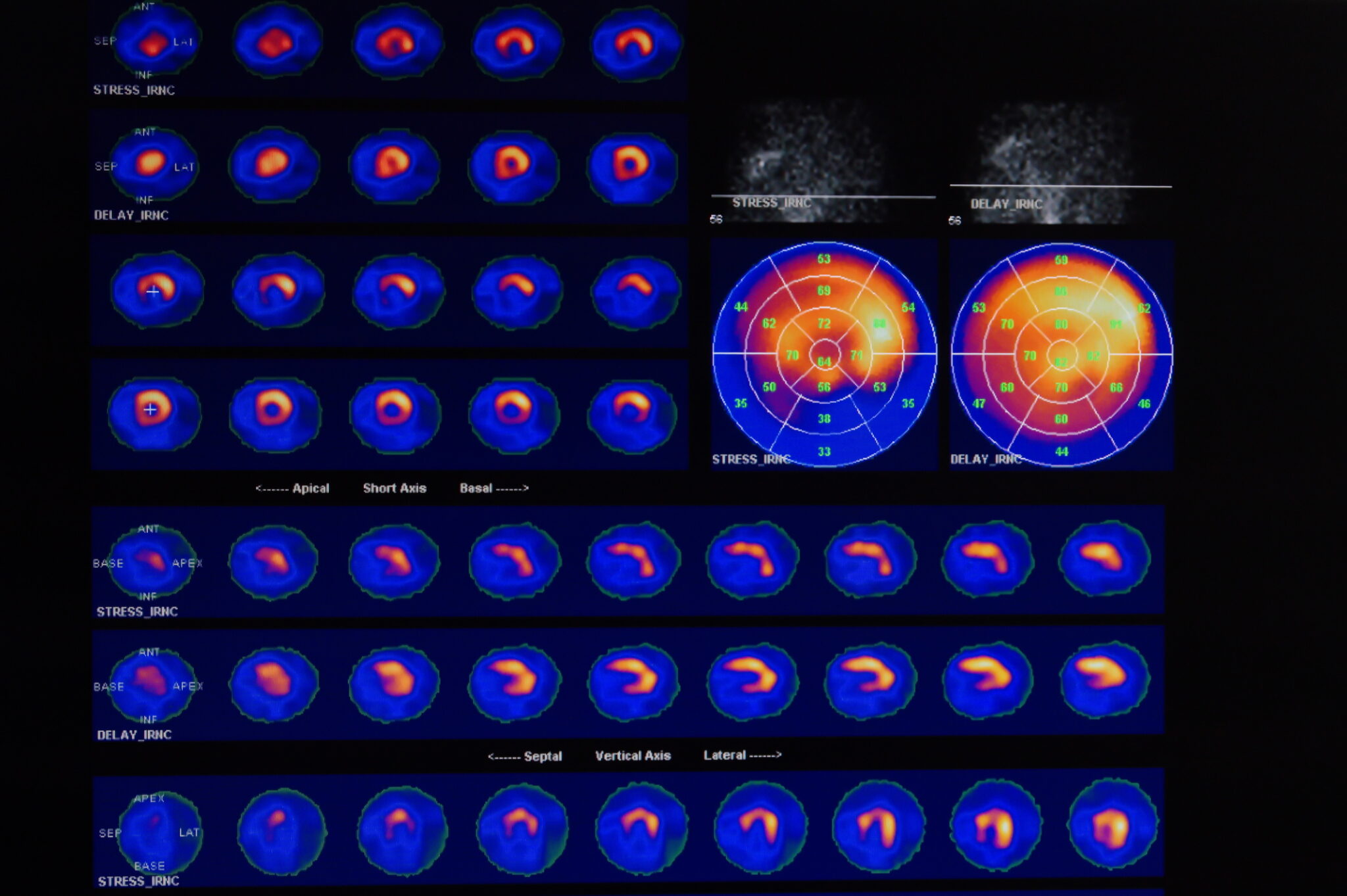 Heart perfusion SPECT scan evaluates blood flow to heart muscle