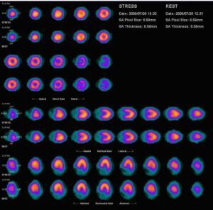 Technetium-99m radiopharmaceuticals used in heart scanning