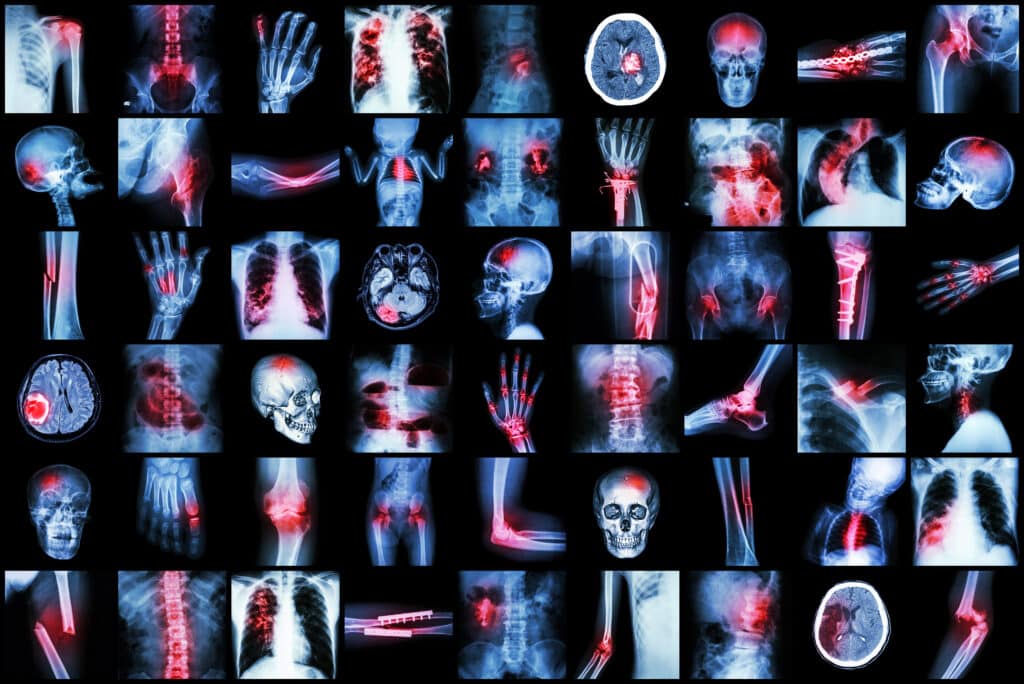 Diagnostic X-rays, discovered in 1895 by Wilhelm Roentgen, revolutionised medical imaging