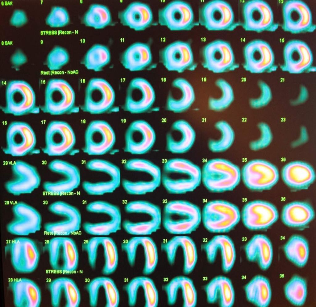 Myocardial perfusion stress test assesses heart function using nuclear medicine imaging