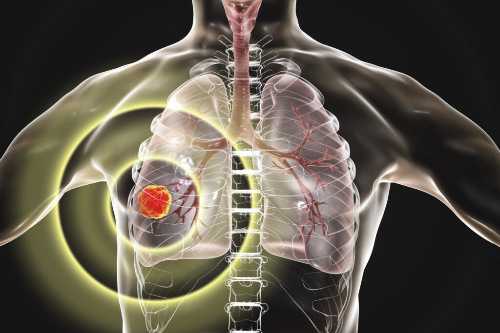 Radiotheranostics is revolutionising cancer care through personalised, targeted radioactive treatments