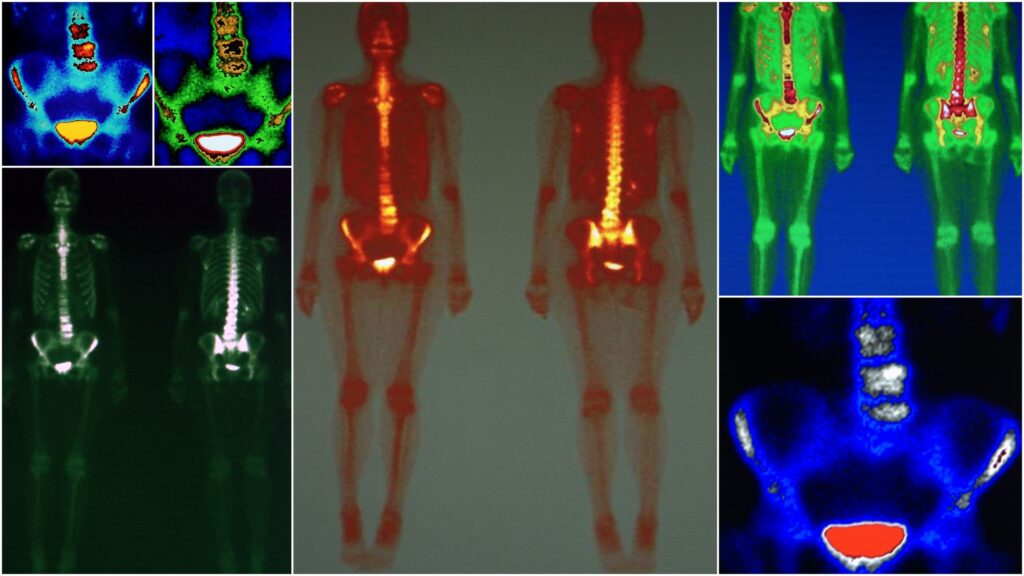 Nuclear medicine plays an essential role in diagnosing various complex conditions