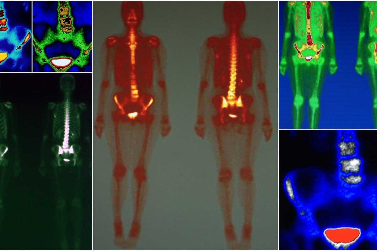 Nuclear medicine plays an essential role in diagnosing various complex conditions