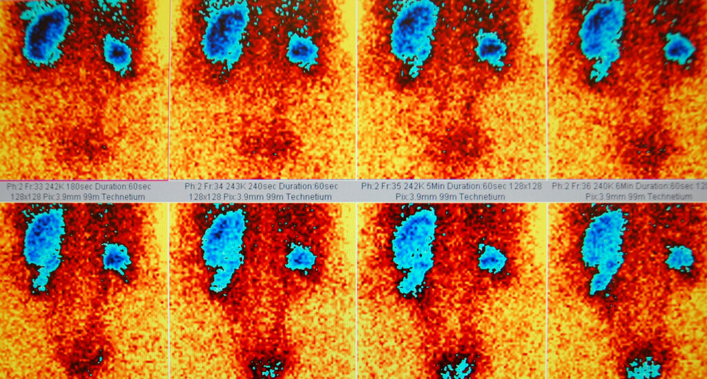 Therapeutic nuclear medicine targets cancer cells with precise radioactive treatments