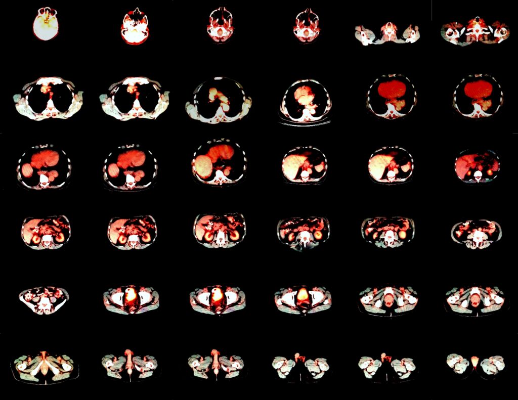 Recent advancements in PET technology improve resolution, speed, and diagnostic accuracy