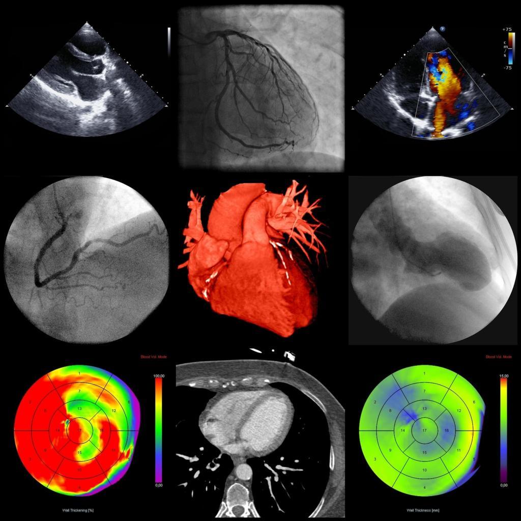 A series of cardiac imaging techniques improves heart disease diagnosis and treatment