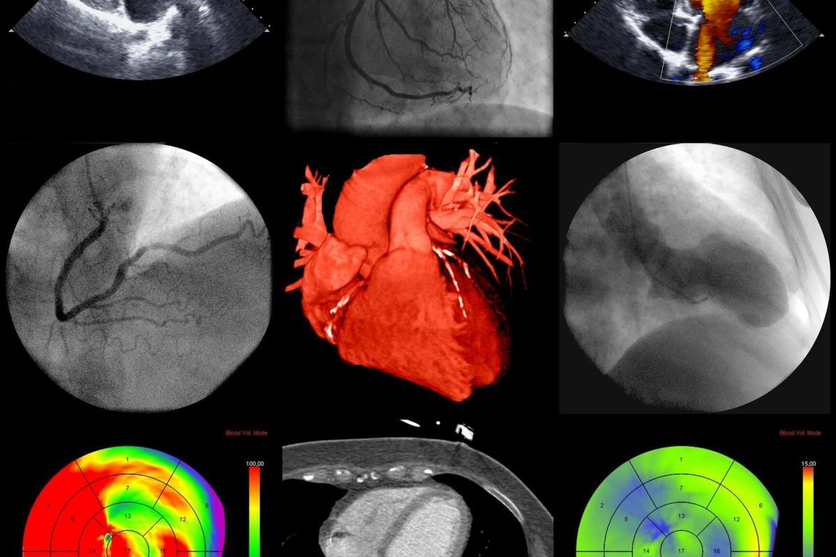A series of cardiac imaging techniques improves heart disease diagnosis and treatment