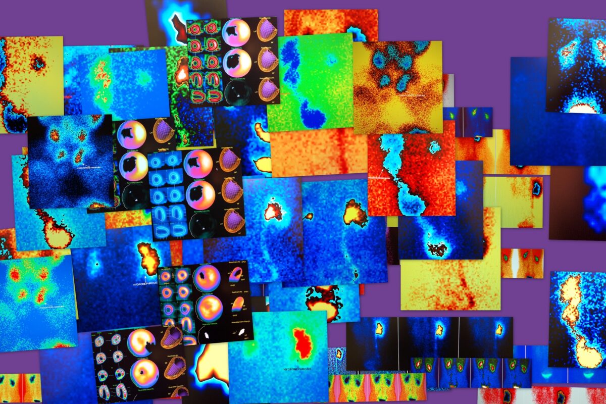 AI enhances imaging, diagnosis, and treatment precision in nuclear medicine