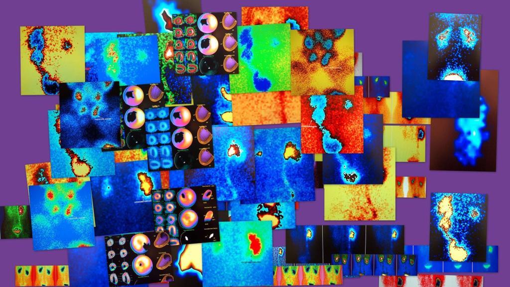 AI in nuclear medicine enhances imaging, diagnosis, treatment, and patient outcomes