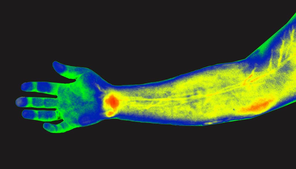 Medical professional using a thermal imaging camera on a patient arm.