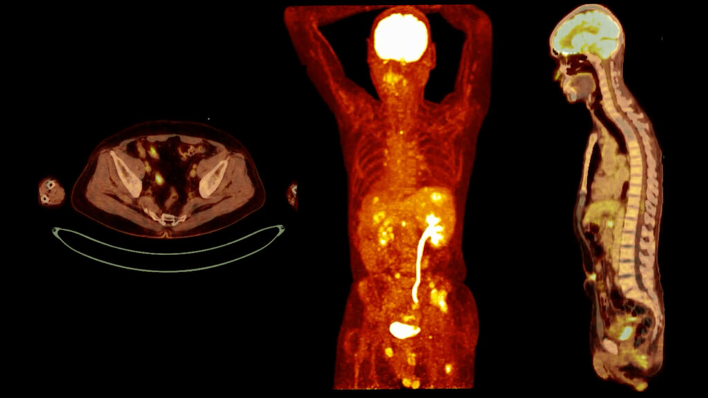 PET scans use a radiotracer to visualize metabolic activity in tissues