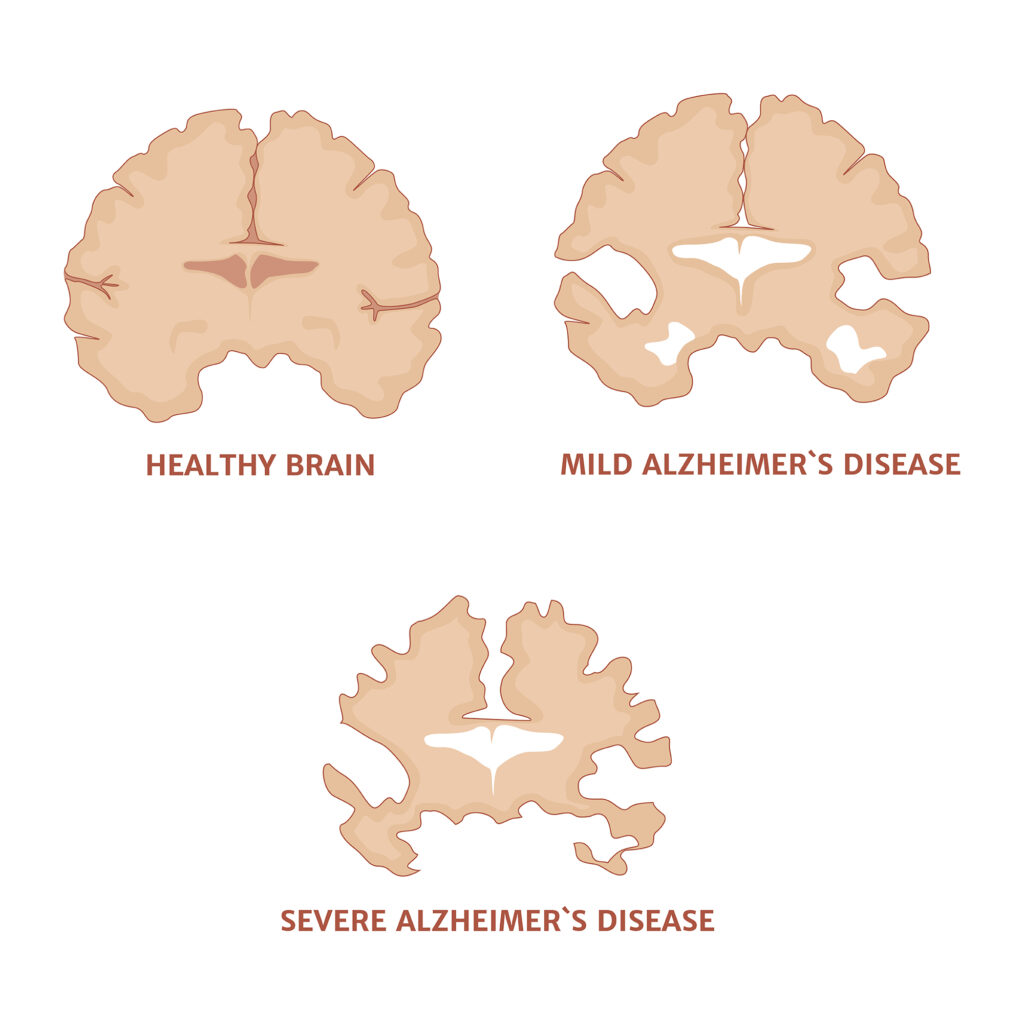 Breakthrough in Alzheimer’s research offers new hope for effective treatment