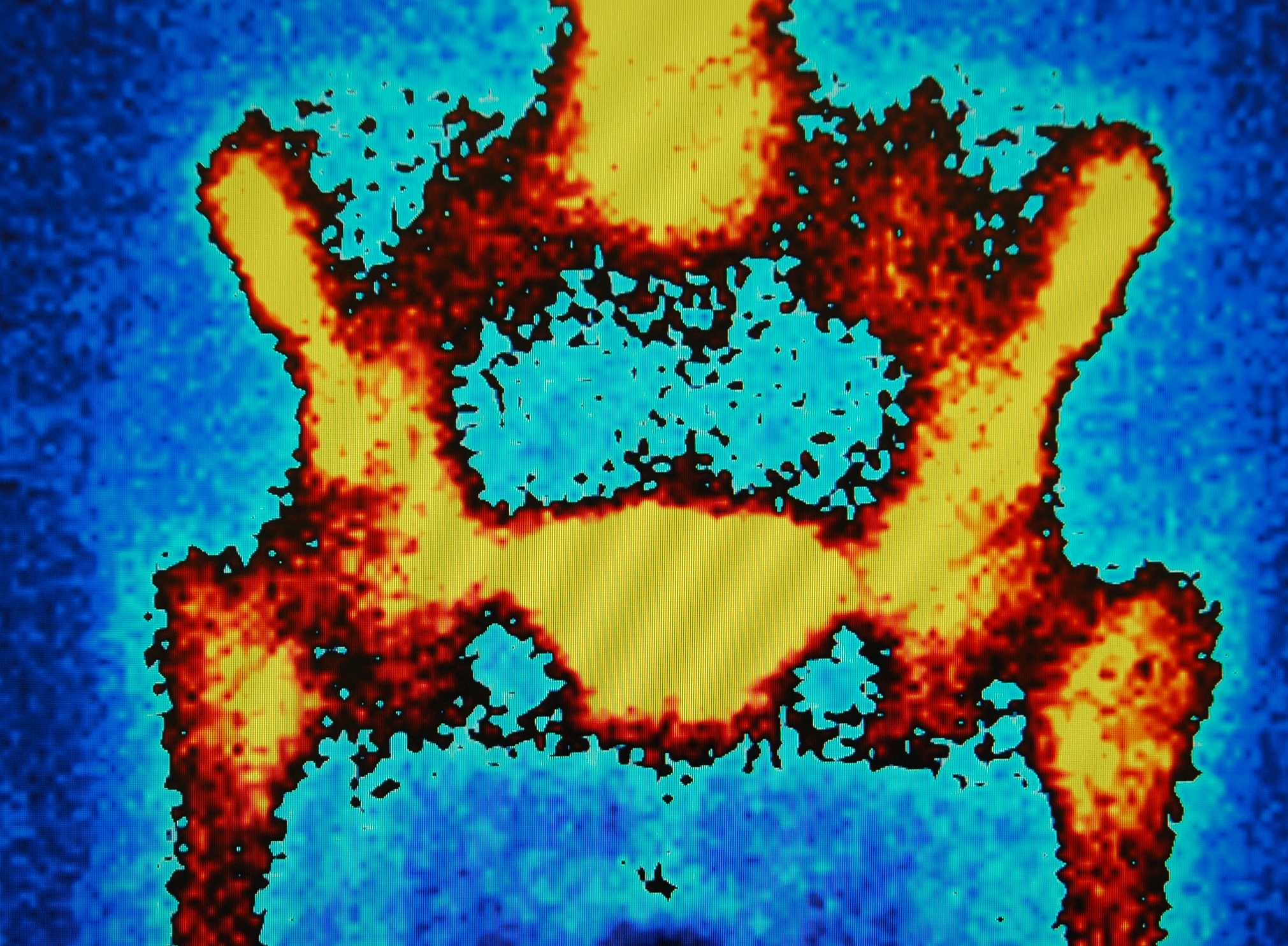Patients with bone metastases often experience pain, fractures, and complications