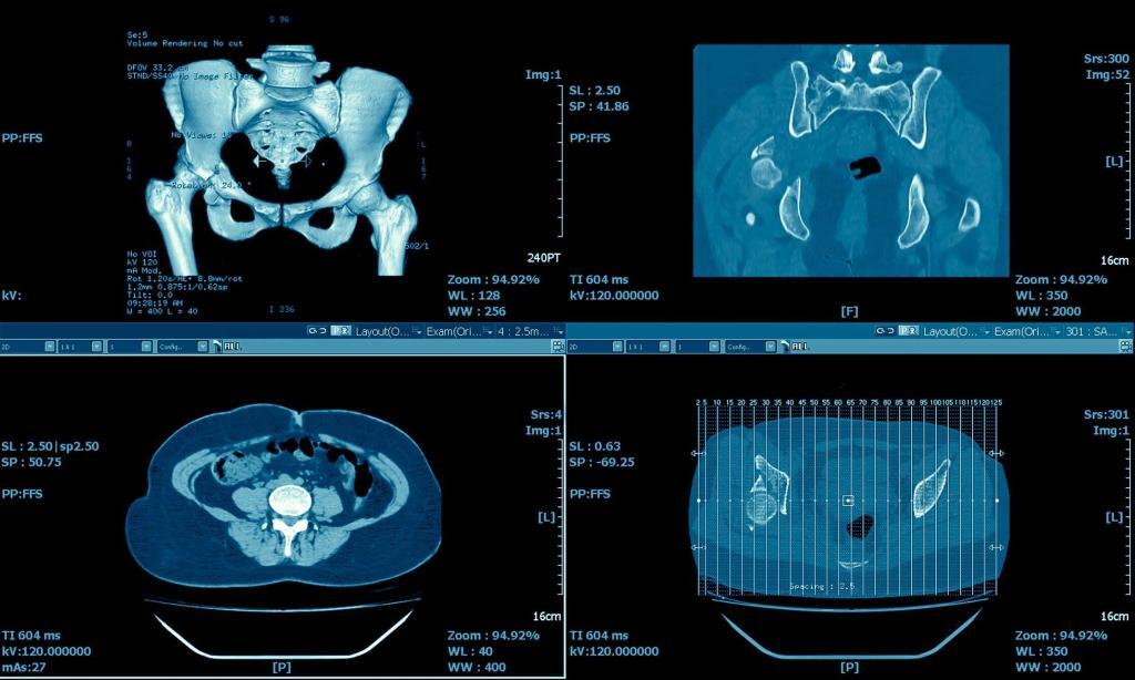 Pneumoperitoneum detection in abdominal CT scans aids rapid diagnosis