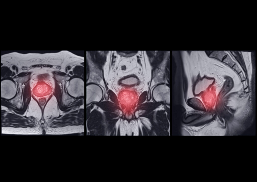 Radiotheranostics combines diagnosis and therapy in treating prostate cancer effectively