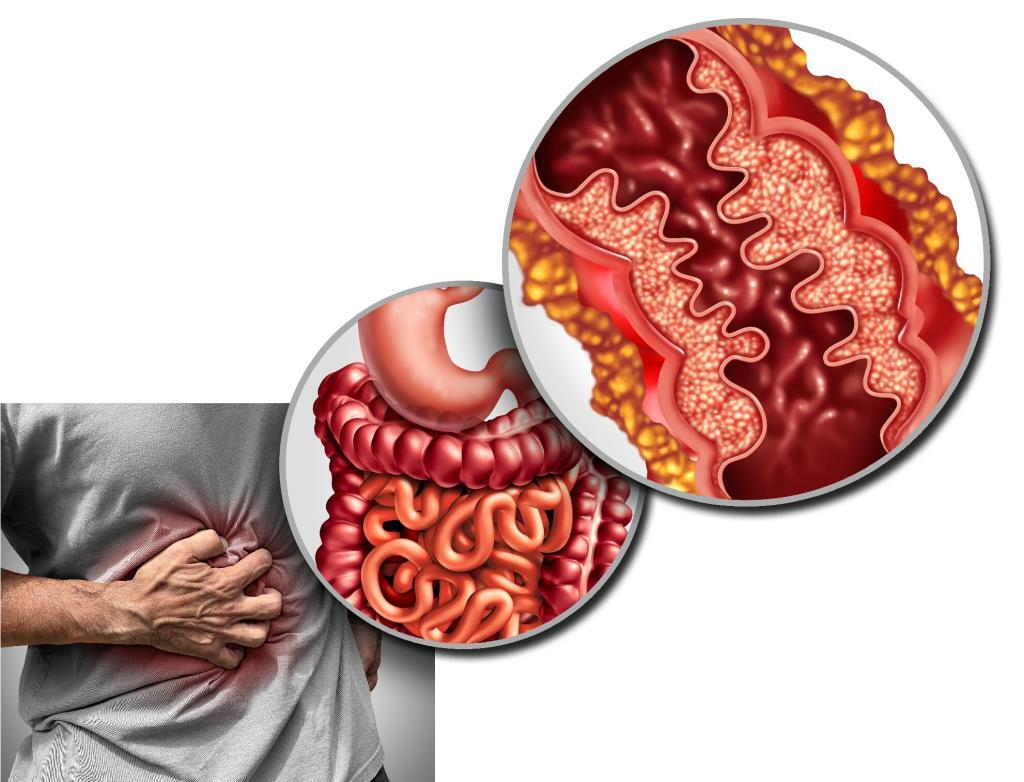 Radiomics and machine learning improve Crohn’s disease diagnosis, accuracy, and treatment planning