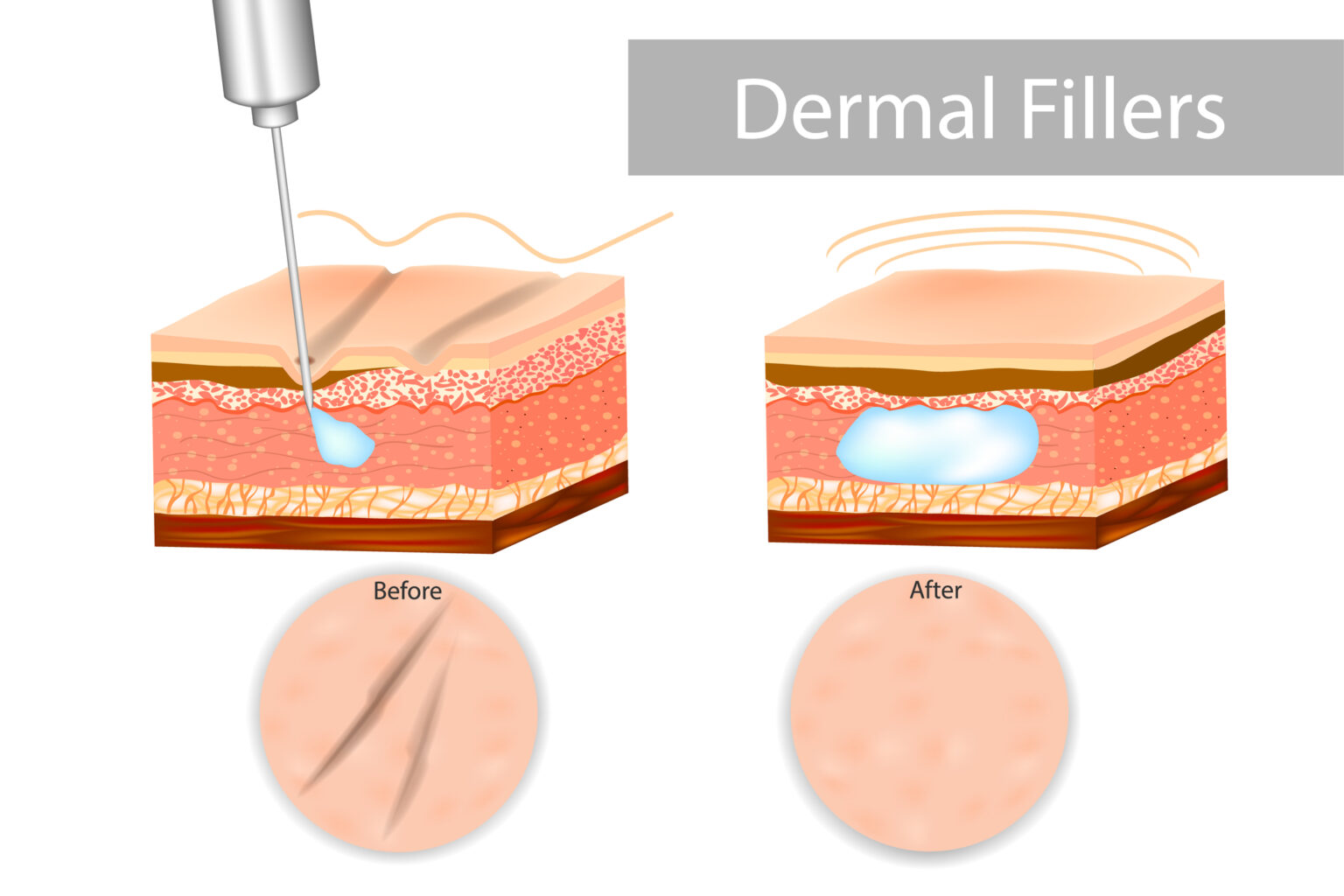 Fillers restore volume and smooth ageing signs in hands and neck
