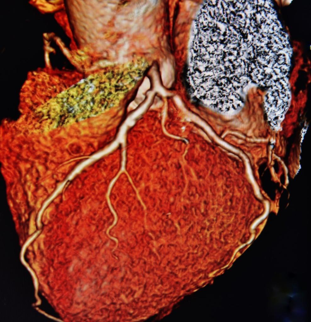 Deep learning improves coronary CT angiography by enhancing accuracy and diagnostic efficiency