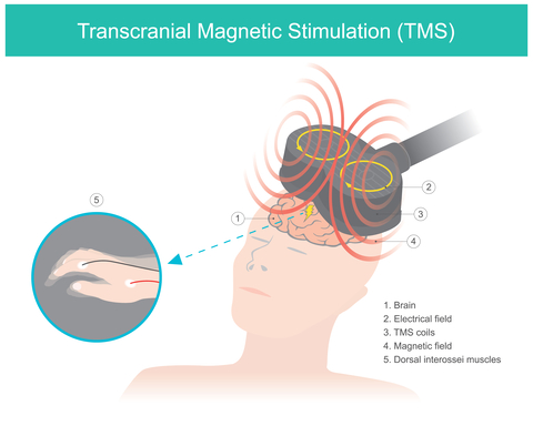 Transcranial Magnetic Stimulation - TMS