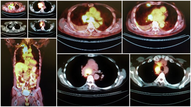 Astatine-211 MABG offers targeted radiotherapy for malignant pheochromocytoma treatment effectiveness