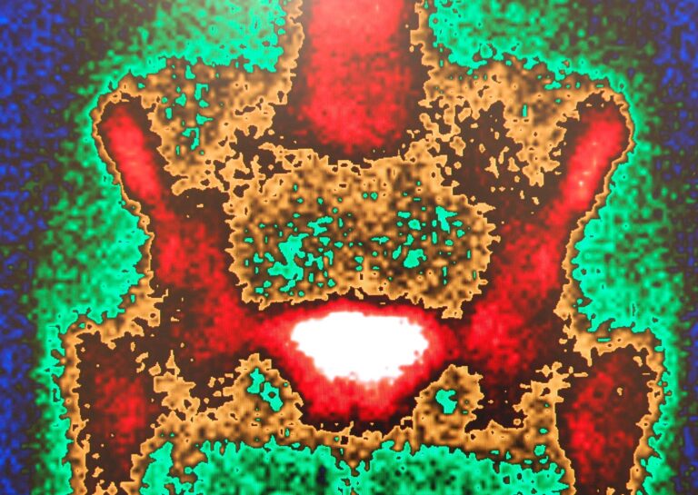 Bone-seeking agents help manage bone metastases by reducing pain and progression