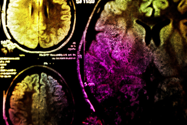 Alpha radiation enhances brain tumour treatment by delivering precise and targeted therapy