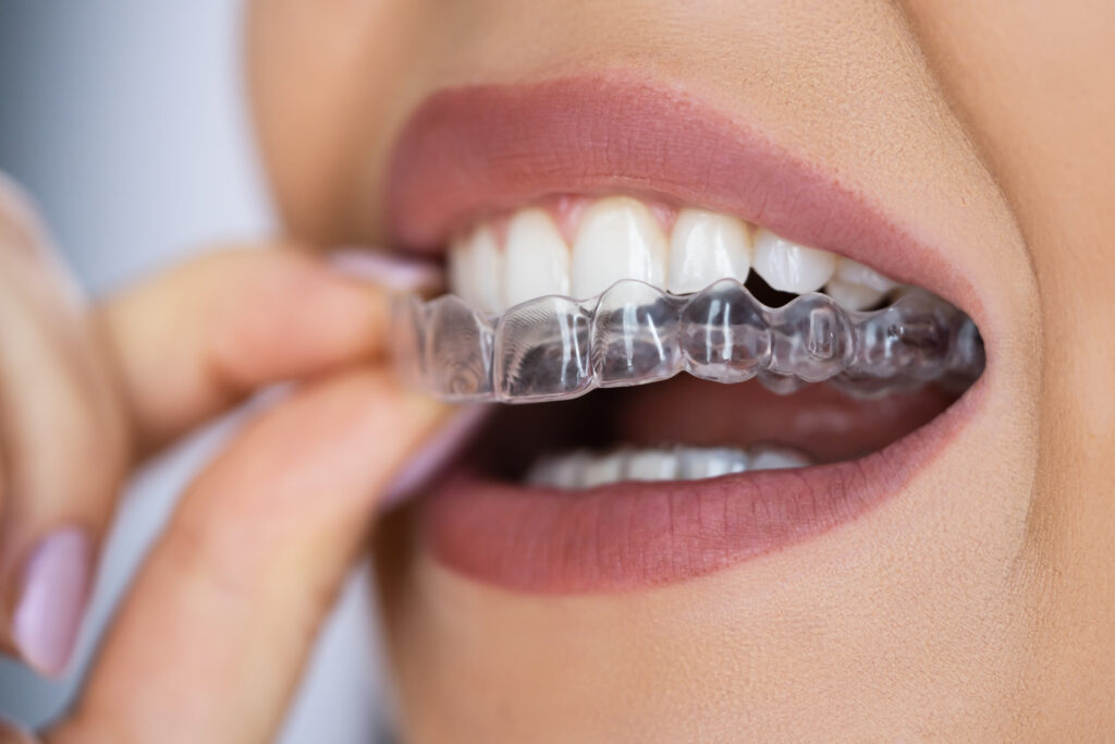 Clear aligners offer discreet, modern orthodontic treatment for straighter teeth
