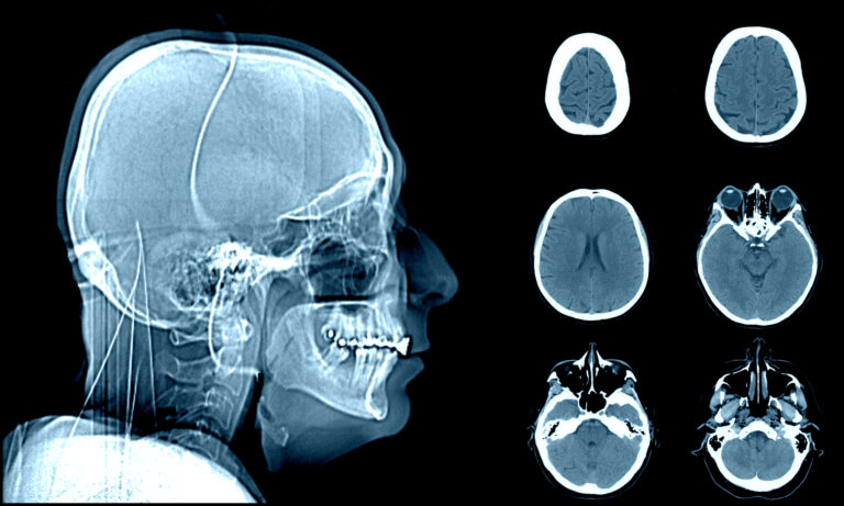 Computed Tomography (CT) scans provide detailed internal images using X-rays