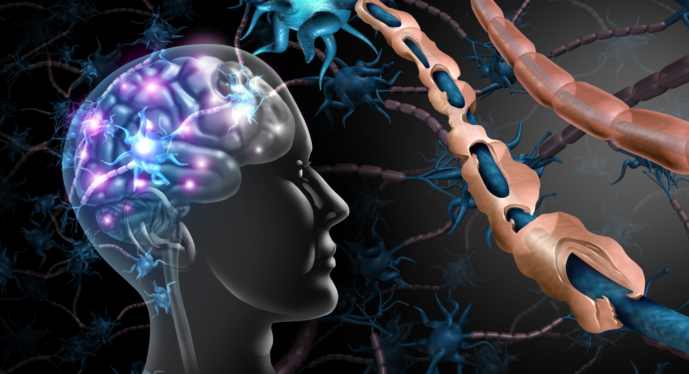 Medical imaging in multiple sclerosis improves diagnosis, monitoring, and treatment decisions