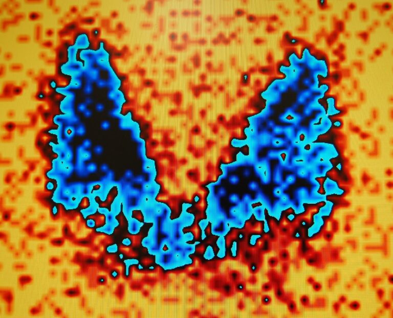 The next generation in thyroid disease treatment enhances precision, efficacy, and patient outcomes