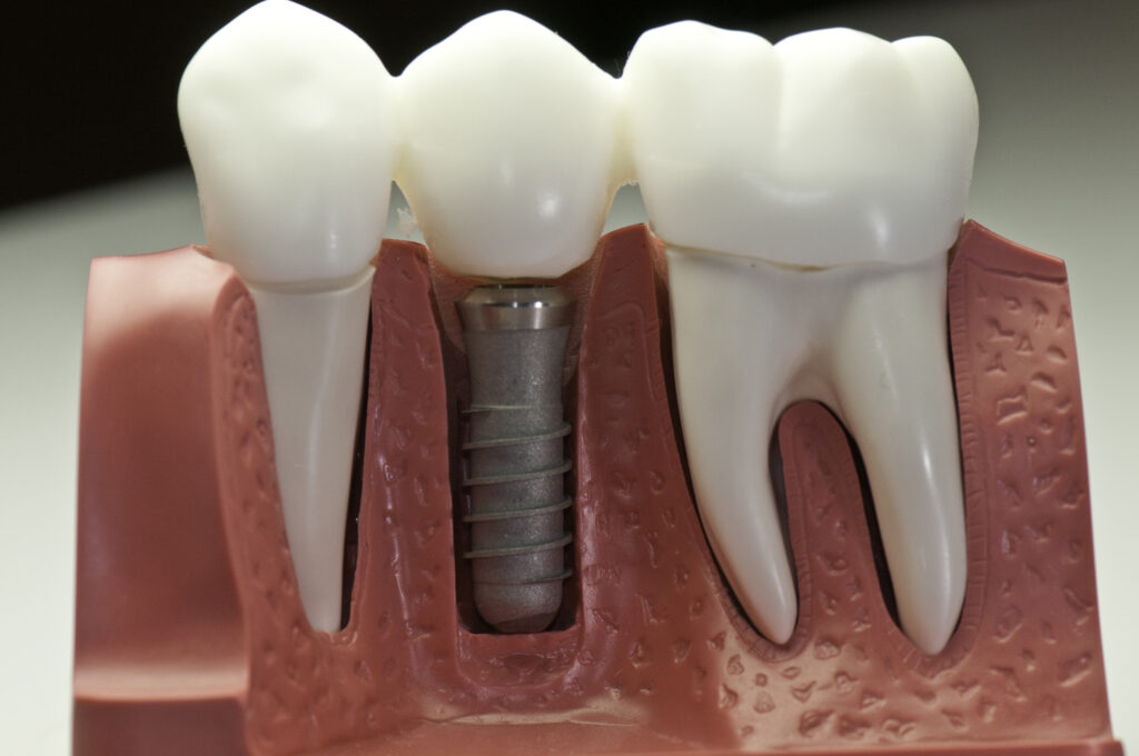 A dental crown restores tooth strength, function, and natural appearance effectively