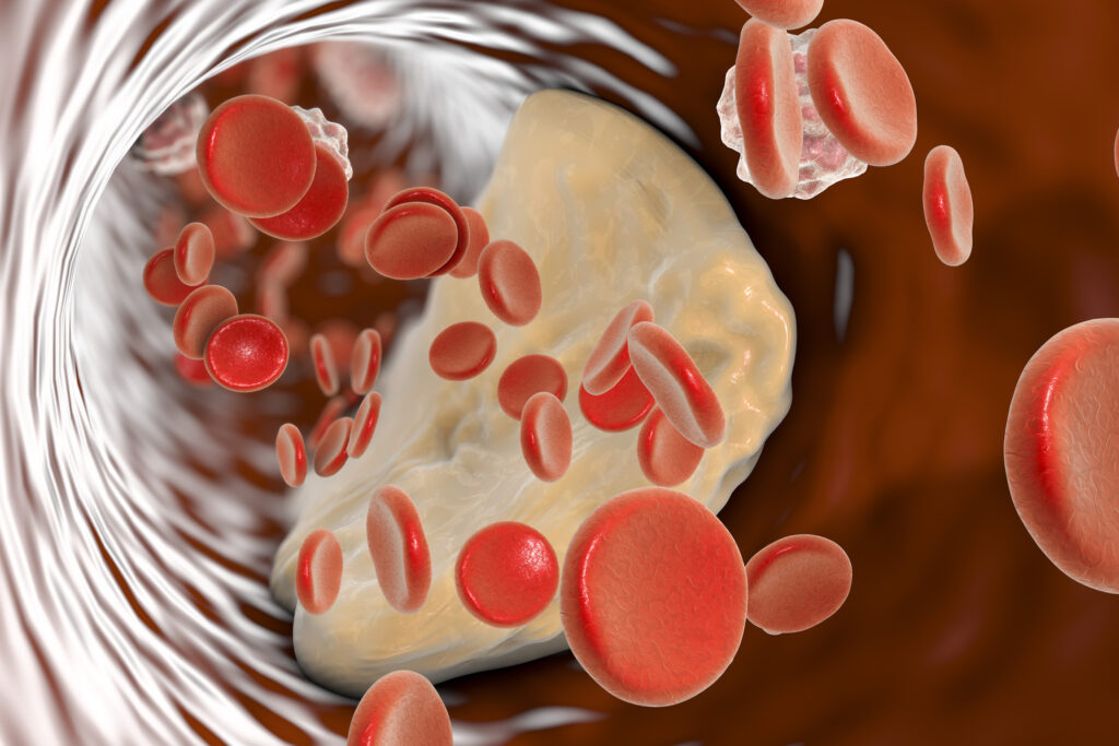 ¹⁸F-Fluoride effectively marks unstable atheroma in vascular imaging studies