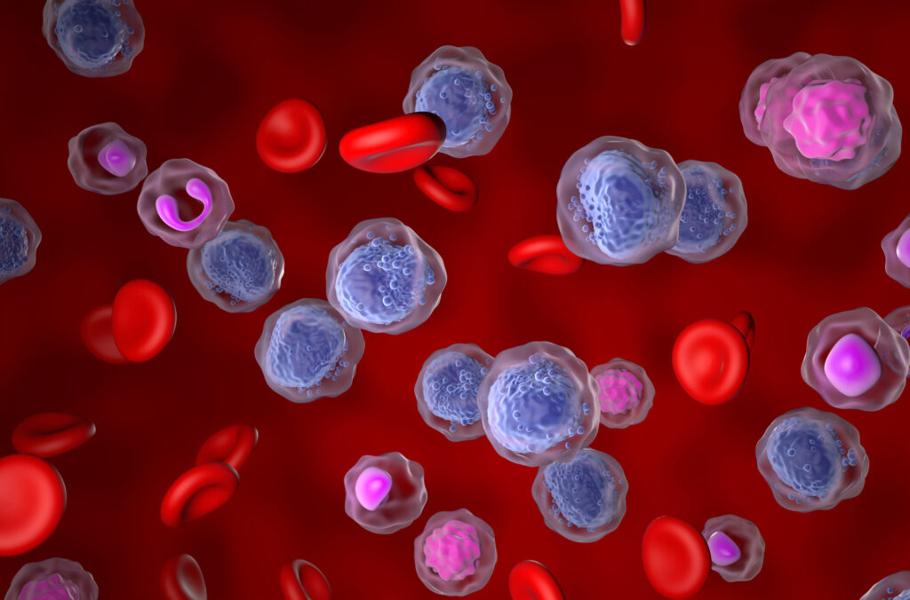 Acute myeloid leukaemia treatment combines chemotherapy, targeted drugs, and transplants