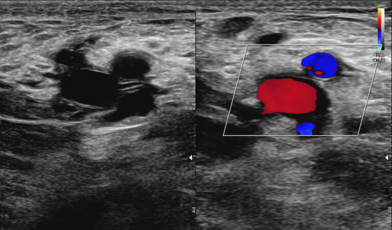 Ultrafast Doppler Imaging captures rapid blood flow, transforming vascular diagnostics