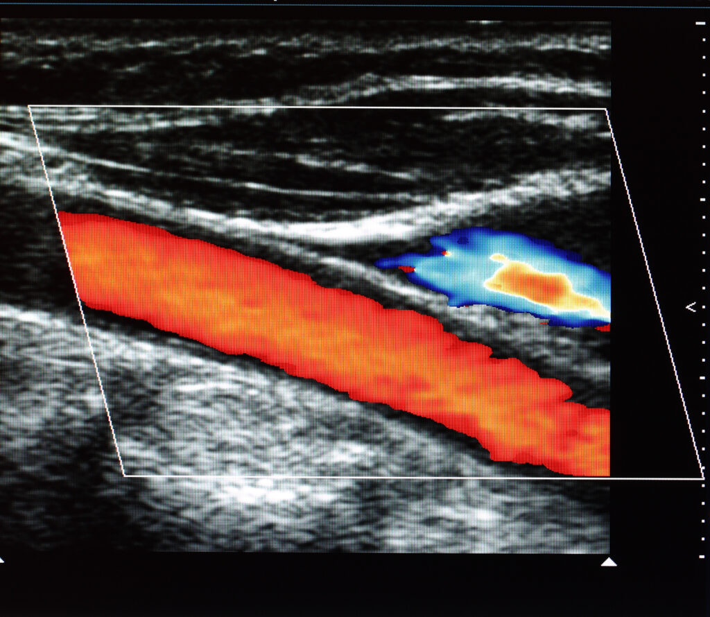 Ultrasound imaging uses sound waves to visualise internal body structures