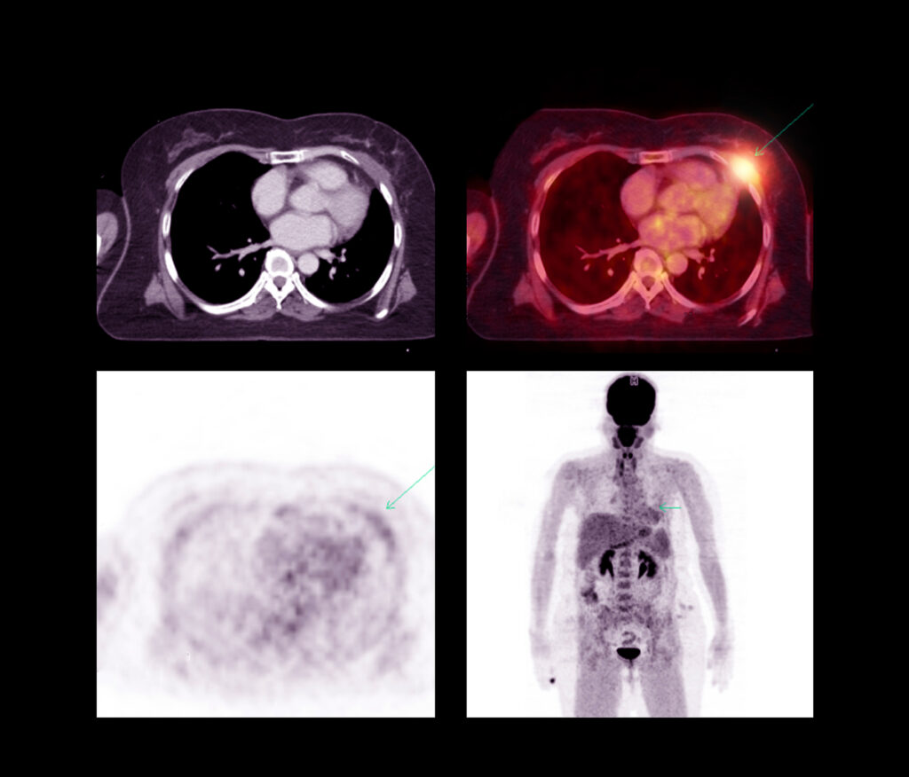 Hybrid imaging combines PET with MRI and CT for enhanced diagnostics