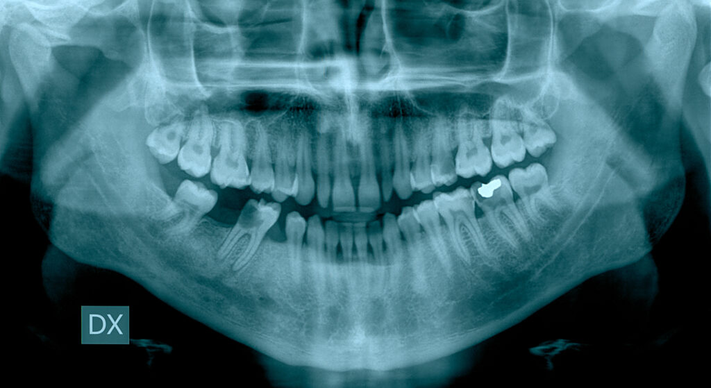 Regular dental checkups are key to preventing serious gum disease