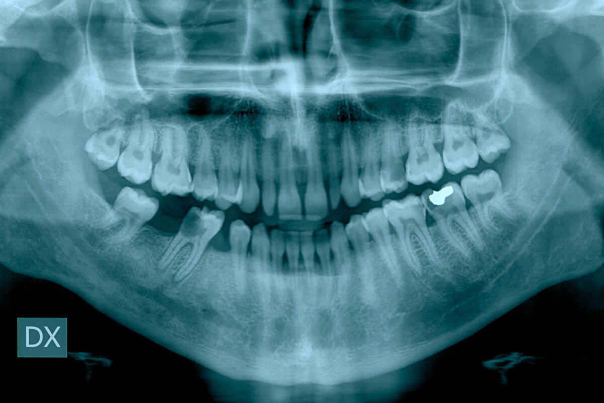 Regular dental checkups are key to preventing serious gum disease