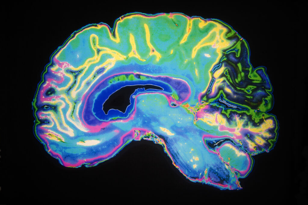 MR-based attenuation correction improves PET imaging accuracy in brain studies