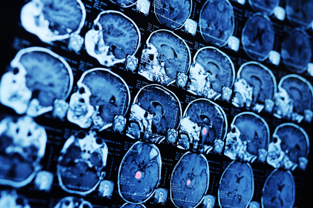 MR Imaging Magnetic Resonance Imaging is a non-invasive technique for medical diagnosis