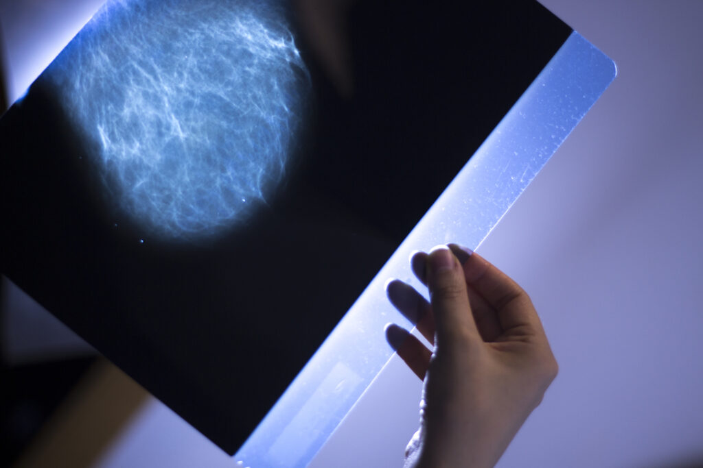 Mammography Mammography uses low-dose X-rays to detect breast cancer early