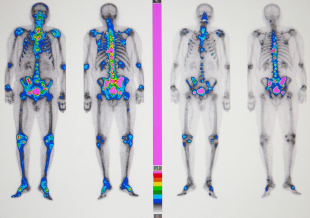 Nuclear Medicine Nuclear medicine uses PET and SPECT scanners for functional imaging