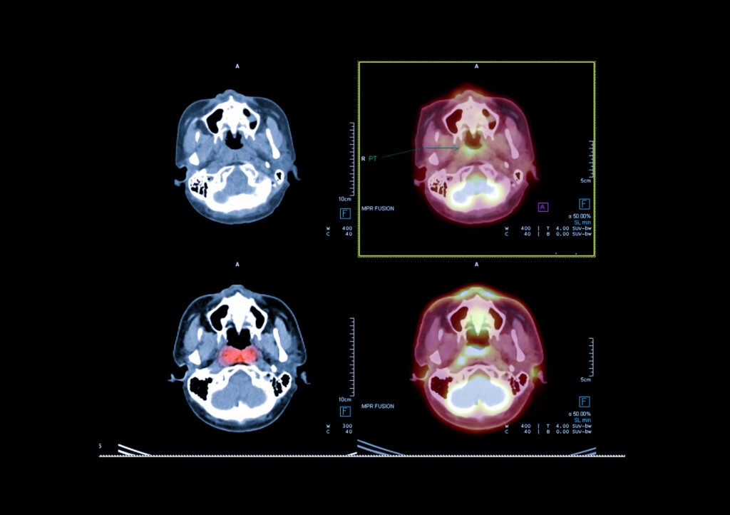 Nucleoside transporters enhance PET imaging by targeting cellular metabolic activity